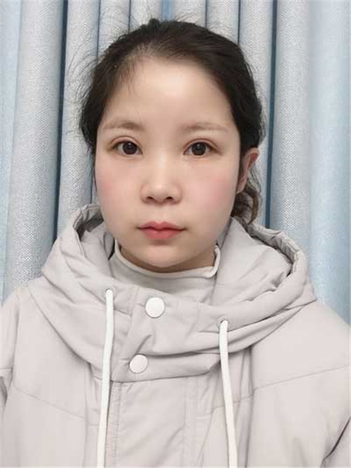 上海艺星杨国正割双眼皮怎么样？案例价格