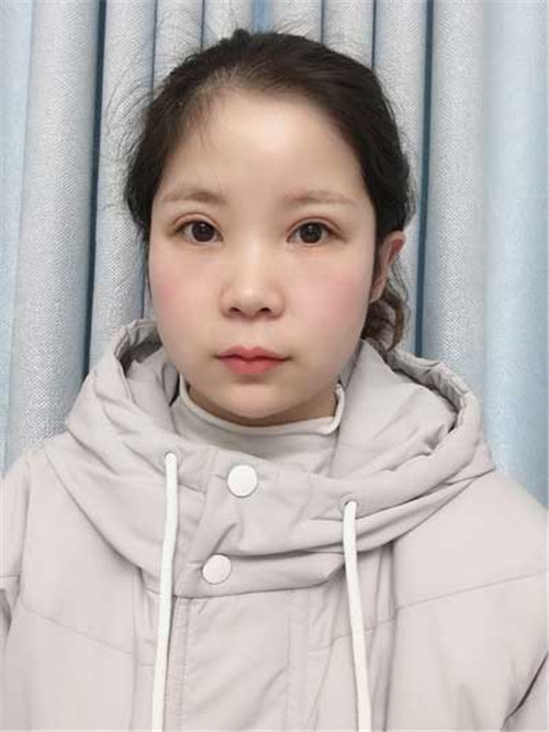 上海艺星杨国正割双眼皮怎么样?案例价格