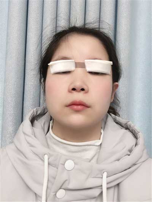 上海艺星杨国正割双眼皮怎么样?案例价格