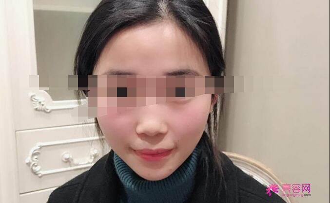 膨体聚四氟乙烯隆鼻靠谱吗?我用我的亲身经历告诉你果怎么样!