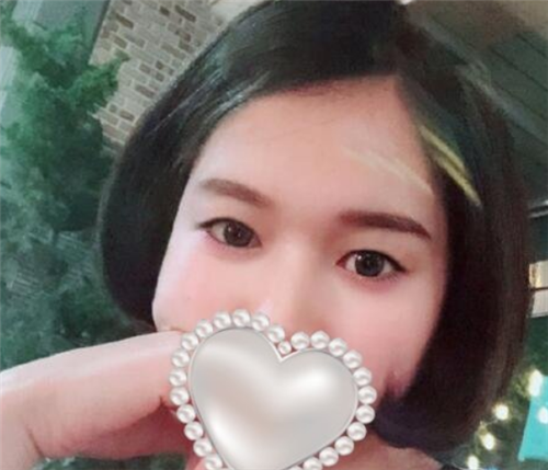 北京爱悦丽格赵映贤割双眼皮怎么样?案例价格