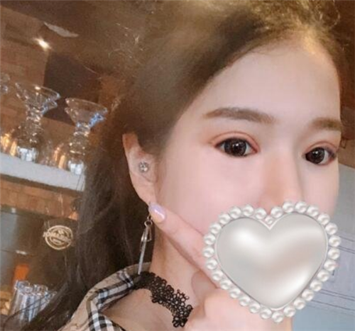 北京爱悦丽格赵映贤割双眼皮怎么样?案例价格