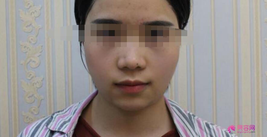 西京医院易成刚案例分享！点进来看看做瘦脸的果怎么样吧！