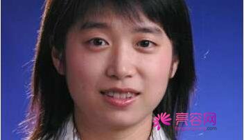 武汉同济曹玮医生做隆鼻怎么样？案例_价格_口碑