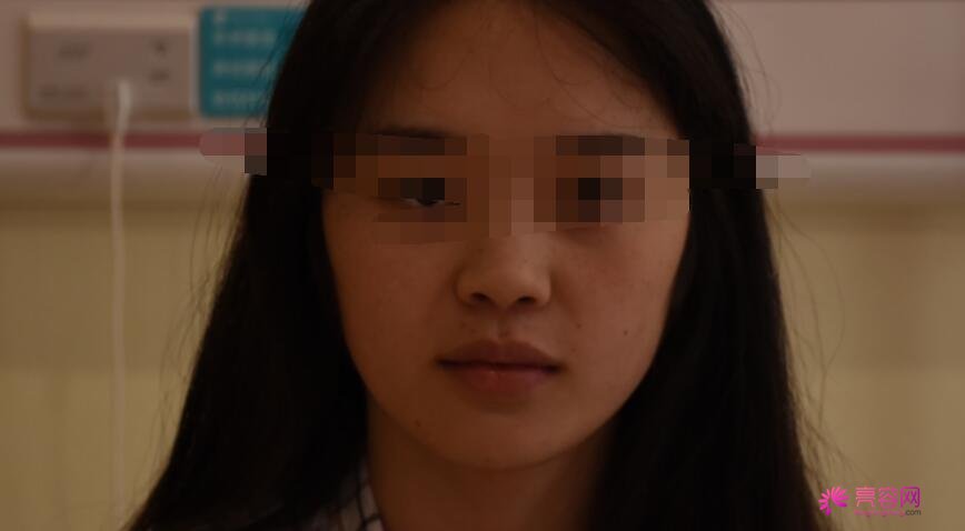武汉同济曹玮医生做隆鼻怎么样？案例_价格_口碑