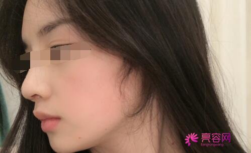 武汉同济曹玮医生做隆鼻怎么样？案例_价格_口碑