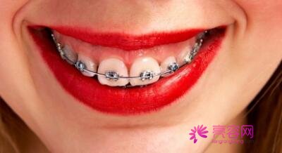 轻微骨性龅牙什么样子呢？应该如何去治疗轻微骨性龅牙呢？