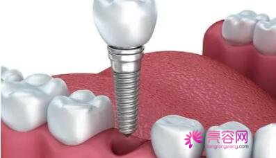 补牙后一般能维持几年呢？补牙时用什么材料比较好呢？真人补牙案例反馈