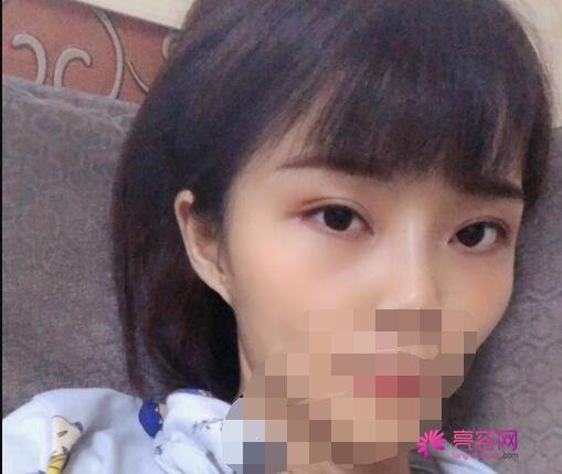 西京医院整形科肖博做双眼皮技术怎么样？医生技术分析+双眼皮案例