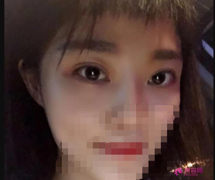 西京医院整形科肖博做双眼皮技术怎么样？医生技术分析+双眼皮案例