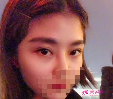 西京医院整形科肖博做双眼皮技术怎么样？医生技术分析+双眼皮案例