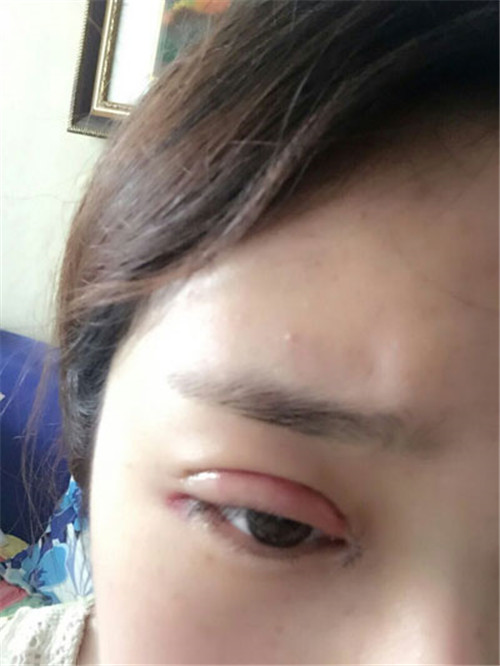 北京韩啸白永辉割双眼皮怎么样?案例_价格口碑