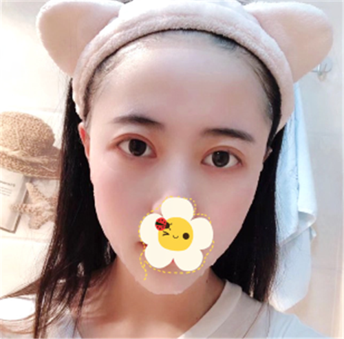 上海艺星唐毅割双眼皮怎么样?案例_价格口碑