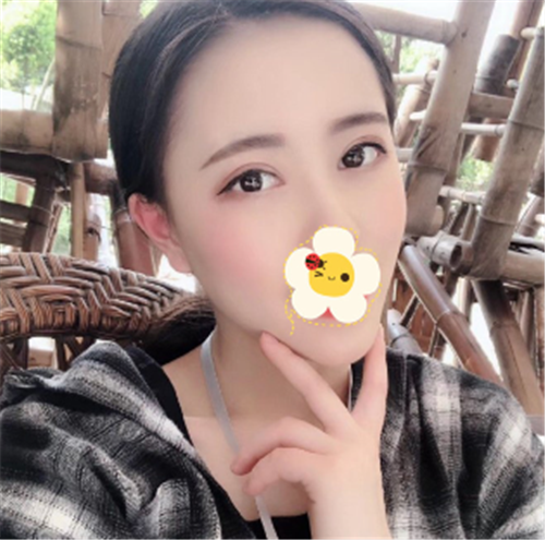 上海艺星唐毅割双眼皮怎么样?案例_价格口碑