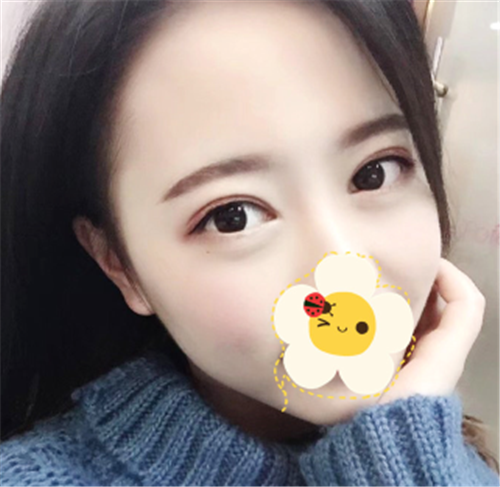 上海艺星唐毅割双眼皮怎么样?案例_价格口碑