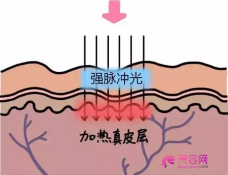 光子嫩肤一次多少钱？影响价格的因素都有哪些？光子嫩肤真人案例