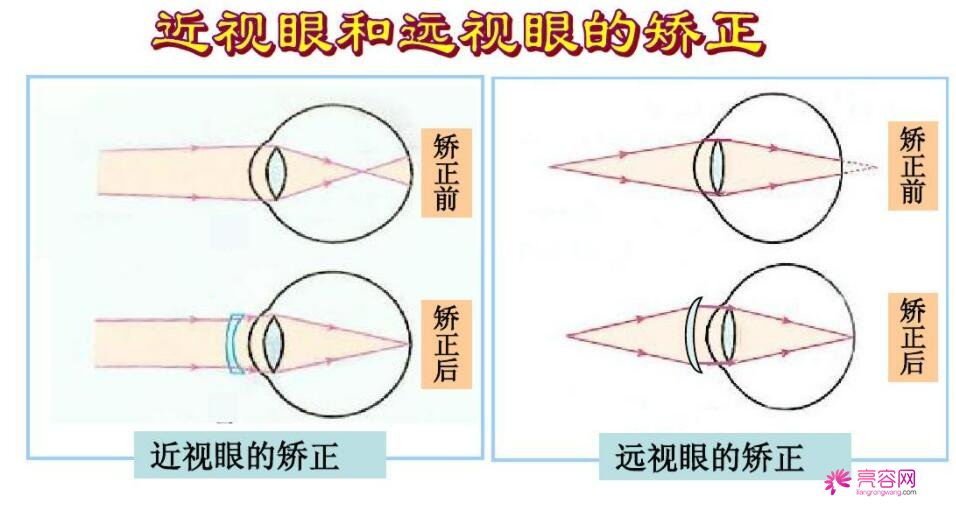 近视眼矫正多久恢复呢？近视眼矫正之后会复发吗？近视矫正手术注意事项