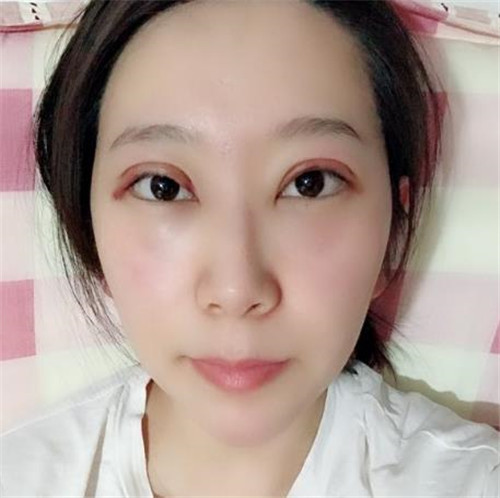 北京画美任召磊割双眼皮怎么样?案例_价格口碑