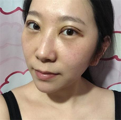 北京画美任召磊割双眼皮怎么样?案例_价格口碑