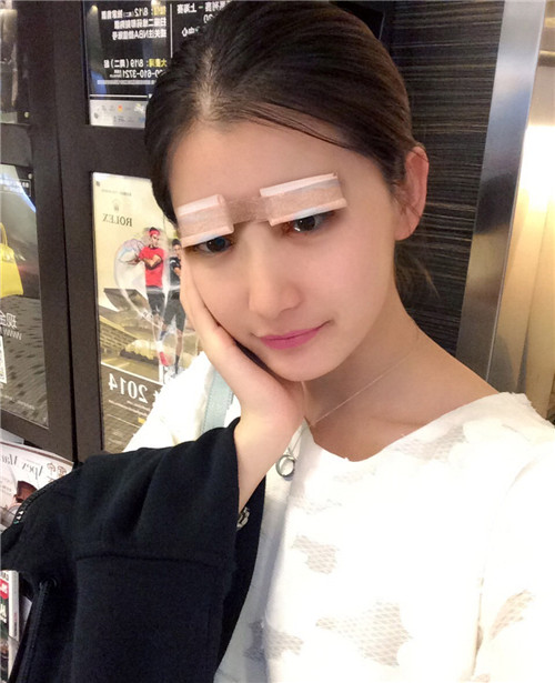 上海艺星李春新割双眼皮怎么样?案例_价格口碑