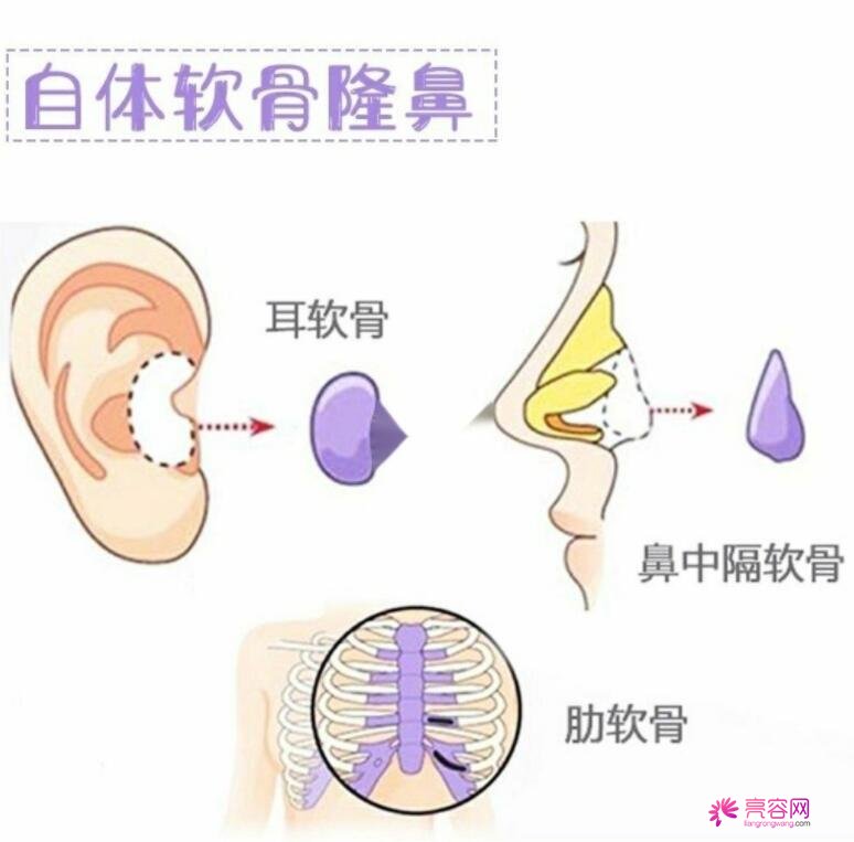 自体软骨隆鼻的手术过程