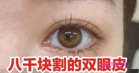 广州飞跃整形医疗美容医院刘海洋医生做双眼皮怎么样？双眼皮案例|价格表