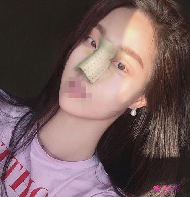 韩国ELLIUM(爱丽美)女性医院崔珉浩医生做隆鼻怎么样？隆鼻前后对比