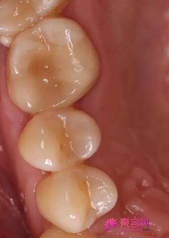 补牙后一般能维持几年呢？补牙时用什么材料比较好呢？真人补牙案例反馈