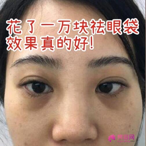 去眼袋真实果前