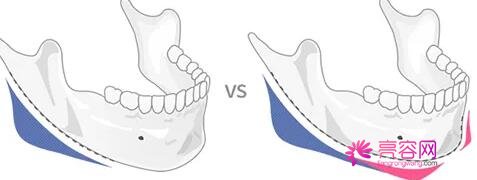 做下颌角整形多少钱