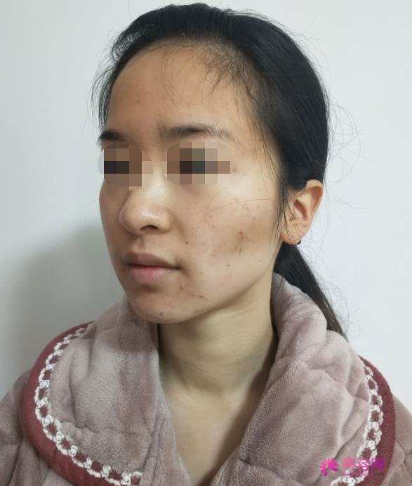 苏州瑞芙臣医疗美容徐增亮医生做除皱怎么样？除皱案例对比|除皱价格表