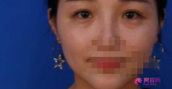 桂林医学院附属医院整形美容的地址在哪呢？做去眼袋果怎么样呢？