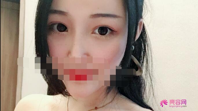 桂林医学院附属医院整形美容的地址在哪呢？做去眼袋果怎么样呢？