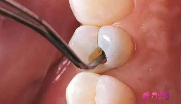 补牙后一般能维持几年呢？补牙的原理是什么呢？都有那些注意事项呢？
