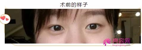 枣庄市立医院整形美容口碑好不好呢？医院荣誉|评价，双眼皮案例