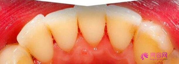 洗牙能让牙齿变白吗？清洁牙齿是有害吗？洗牙费用是多少呢？