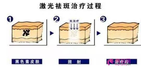 激光祛斑术后怎么避免反黑