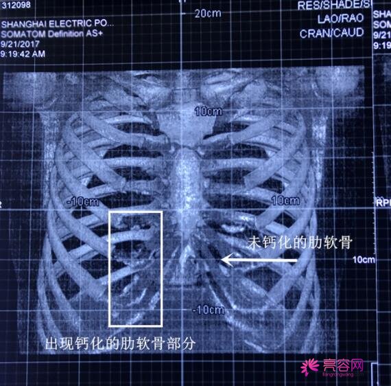 厦门美丽薇整形李国明医生做隆鼻技术如何？医生实力分析+隆鼻案例