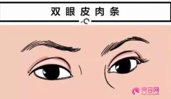 天津眼科医院王小强双眼皮怎么样？医生口碑评价+全切双眼皮果