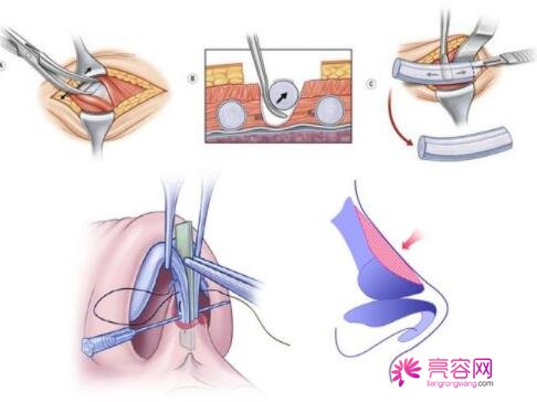 九院宋欣医生价格表2021更新，医生个人信息介绍+隆鼻案例“生态美鼻”