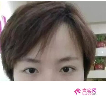 枣庄市立医院整形美容科怎么样？整形医生介绍+双眼皮案例