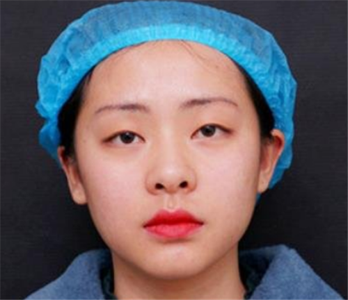 上海艺星黄泽春割双眼皮怎么样?案例_价格