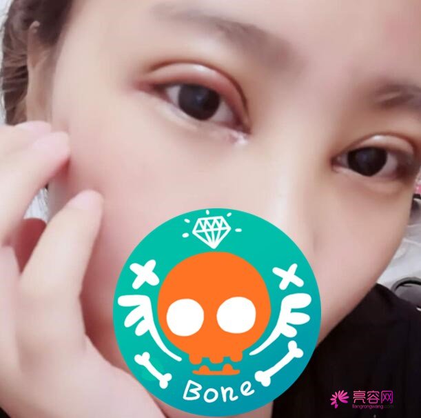 双眼皮手术多少钱一次？价格表2021新版，小仙女割双眼皮案例来啦！