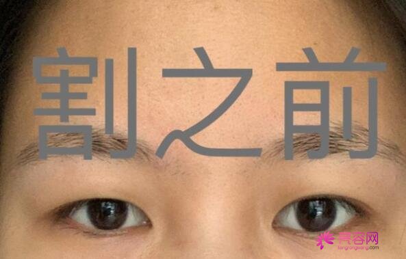 上海九院范海燕双眼皮怎么样？医生实力分析+双眼皮前后对比果