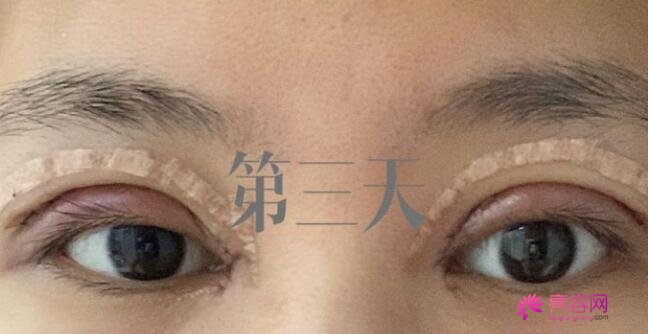 上海九院范海燕双眼皮怎么样？医生实力分析+双眼皮前后对比果