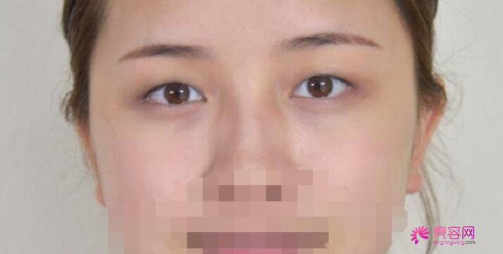 重庆西南医院整形王量医生做双眼皮怎么样？案例_价格_口碑