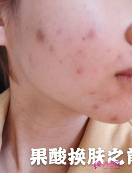 青海大学附属医院皮肤科果酸换肤案例分享：告别痘印、毛孔粗大等问题