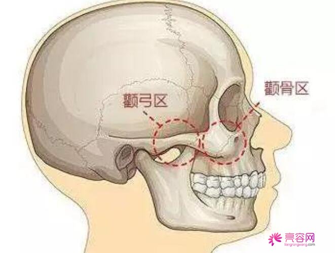 颧骨整形手术有什么风险和后遗症