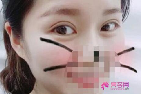 杭州艺星医疗美容医院李慧玲医生做双眼皮怎么样？双眼皮案例别错过！