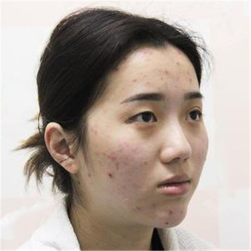 北京叶子汪环割双眼皮怎么样?案例_价格